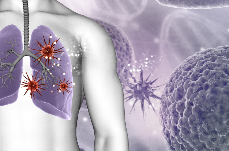 Soft Tissue Tumors